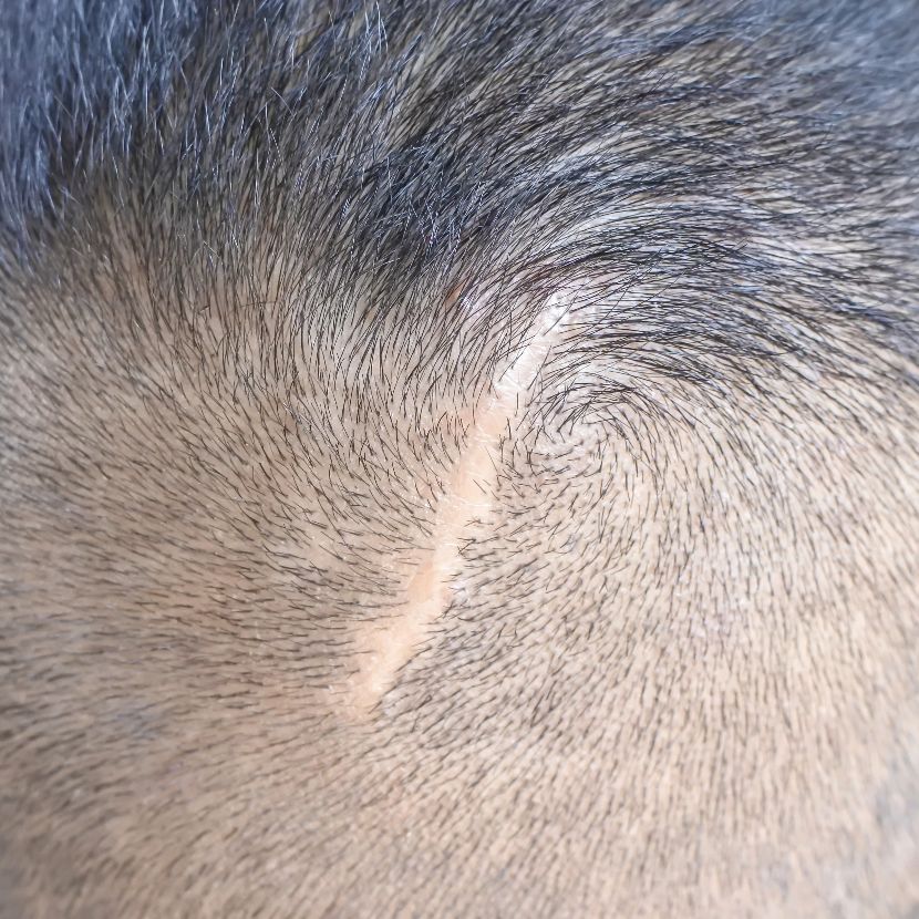 Alopecia cicatricial